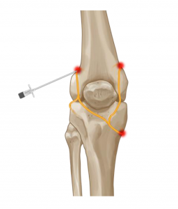 Genicular nerve block – Lowell Pain Center